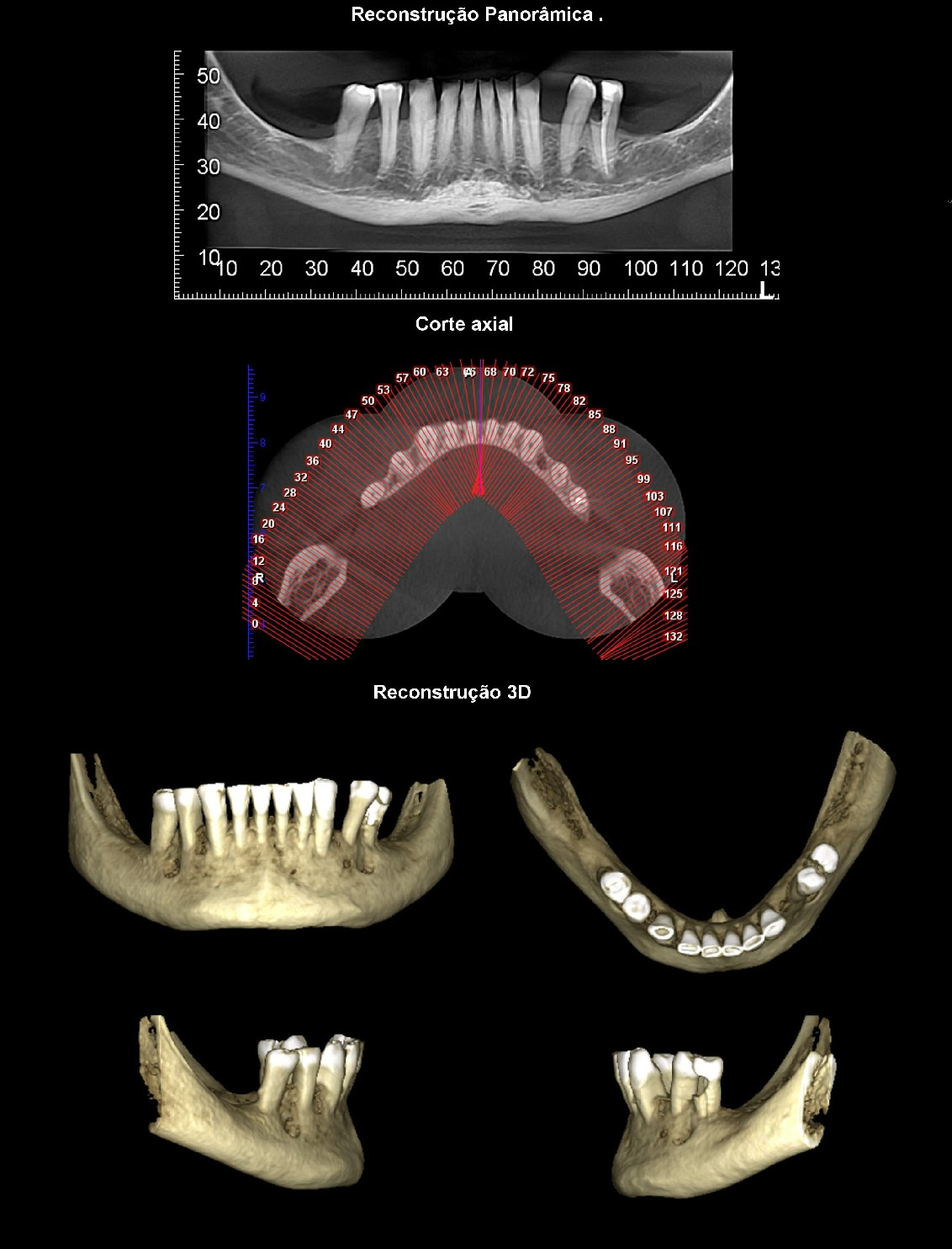 Tomografia para Implantodontia